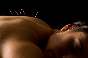 Woman getting an acupuncture treatment 